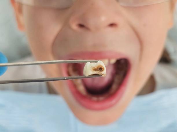 Best Broken or Cracked Tooth Emergency Dentist in Soddy Daisy, TN